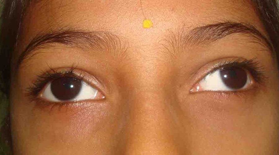 Child with straight, healthy eyes after squint treatment